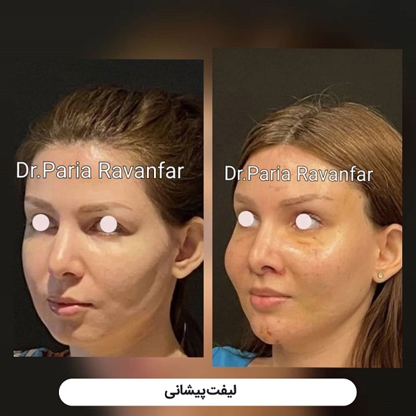 لیفت شقیقه با جراحی و هر آنچه باید درباره آن بدانید