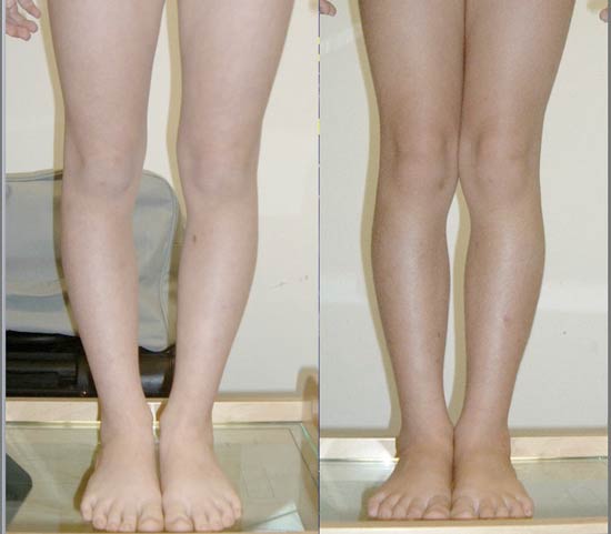 درمان پای پرانتزی بدون جراحی در کلینیک فنی آتل