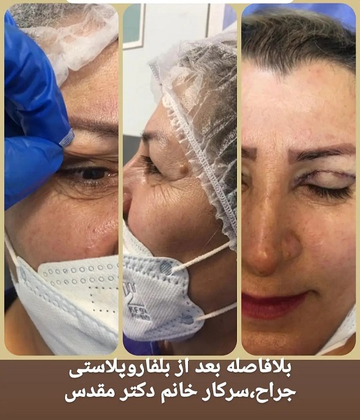 هزینه عمل بلفاروپلاستی (جراحی پلک) در سال 1402 