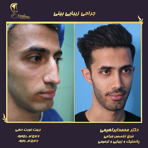 هزینه عمل جراحی بینی در سال 1402 + جدول قیمت