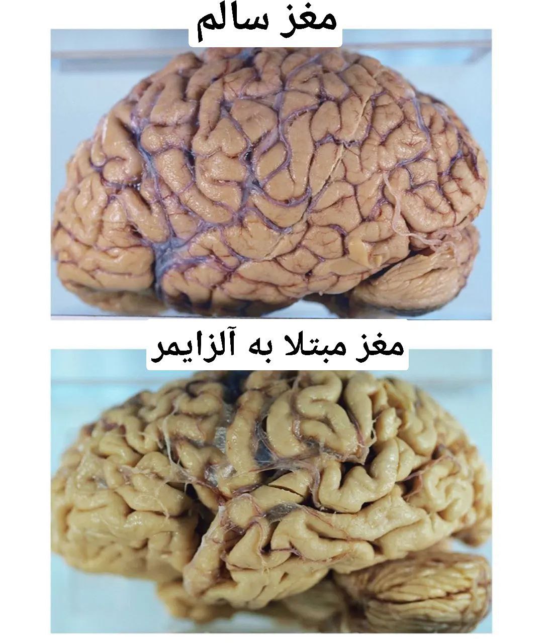 تصویری بسیار عجیب از مغز یک آلزایمری!