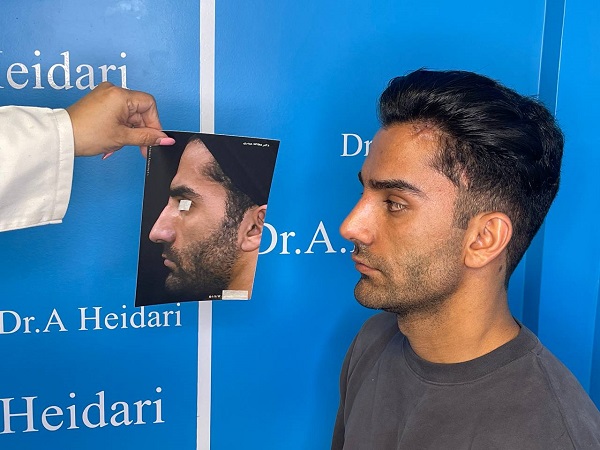 جراحی بینی استخوانی