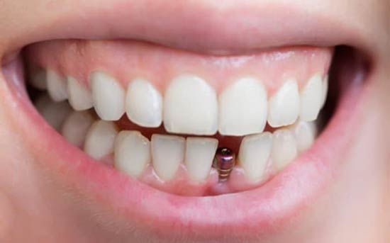 انواع ایمپلنت دندان؛ تفاوت و هزینه‌ی آن‌ها 