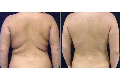 راه ‌حل چاقی موضعی چیست؟