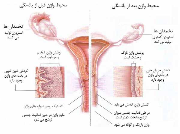 تشخیص و درمان آتروفی واژن | علل و علائم خشکی واژن بعد از یائسگی