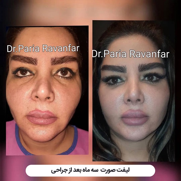 لیفت شقیقه با جراحی و هر آنچه باید درباره آن بدانید