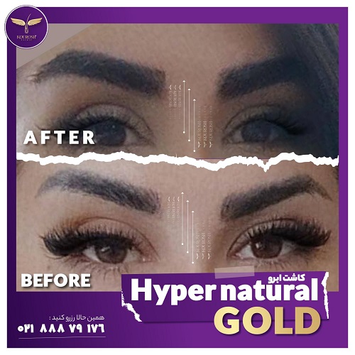 بهترین روش کاشت ابرو کدام است؟ | مراحل کاشت، ماندگاری، مزایا، معایب و هزینه