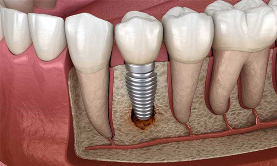 طول عمر ایمپلنت دندان چقدر است؟ ایا ایمپلنت مادام العمر است؟