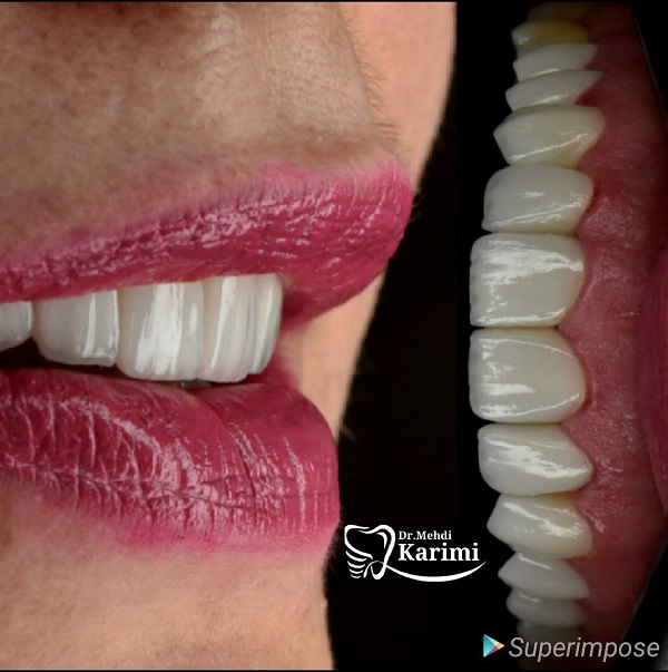 لمینت سرامیکی دندان چیست؟ انواع، مزایا و معایب آن
