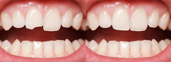 کامپوزیت دندان جلو چیست؟|مراحل،مزایا،عوارض،قیمت و مراقبت‌ها