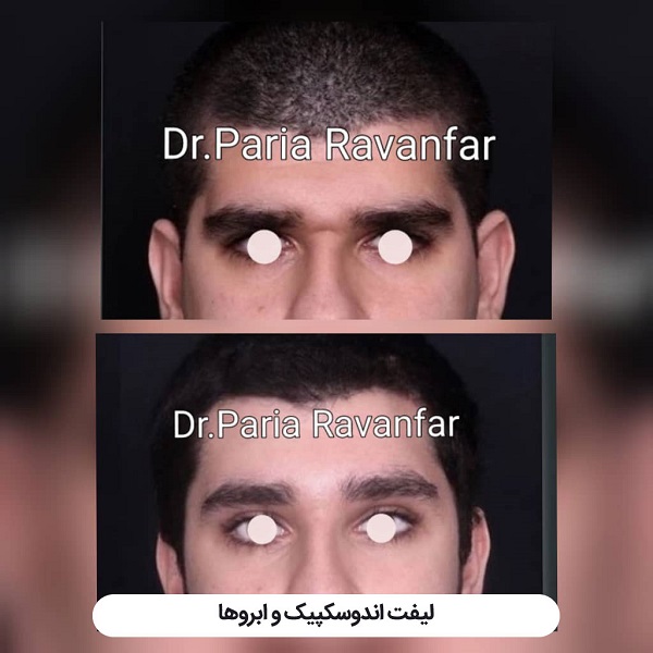 لیفت شقیقه با جراحی و هر آنچه باید درباره آن بدانید