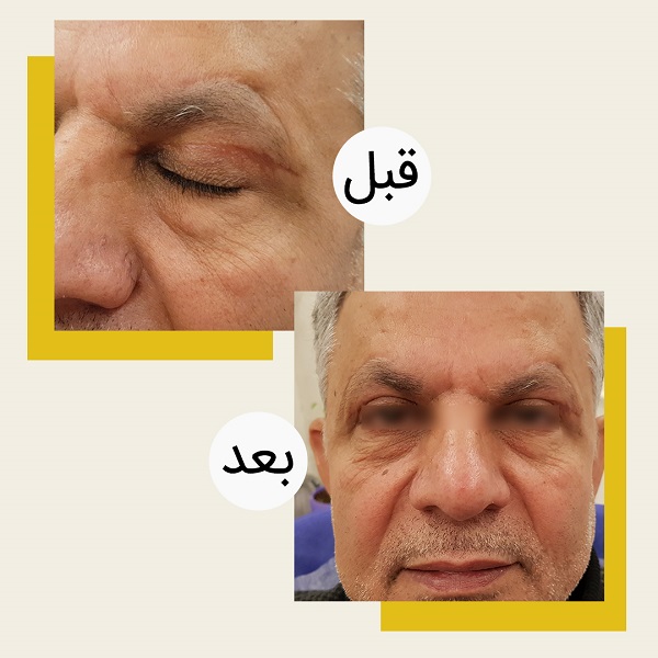 متخصص جراحی پلک در تهران + ویژگی‌های متخصص قابل اعتماد