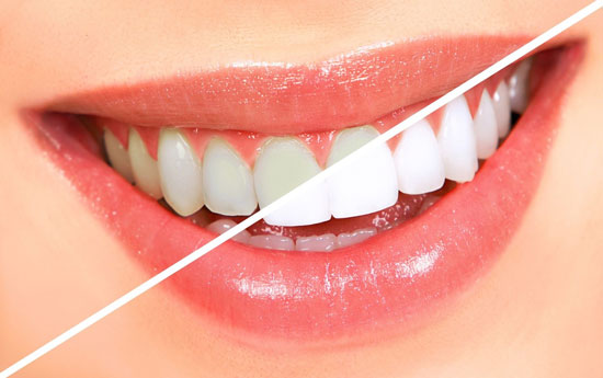 برای انتخاب بهترین لمینت دندان، چه معیارهایی مهم هستند؟