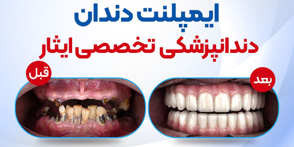 بهترین کلینیک کاشت دندان در شرق تهران- مراحل یک ایمپلنت دندانی