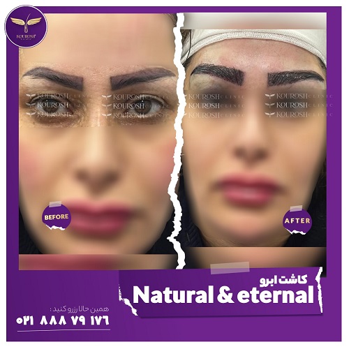 بهترین روش کاشت ابرو کدام است؟ | مراحل کاشت، ماندگاری، مزایا، معایب و هزینه