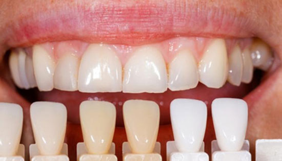 بررسی و مقایسه بهترین نوع کامپوزیت دندان