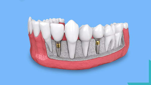 ایمپلنت دندان چیست؟ (بررسی کامل Dental Implant)