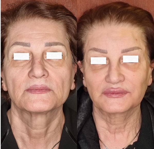 اندولیفت برای جوانسازی چگونه انجام می‌شود؟