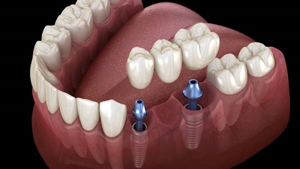 افزایش طول عمر ایمپلنت دندان + مشاوره رایگان