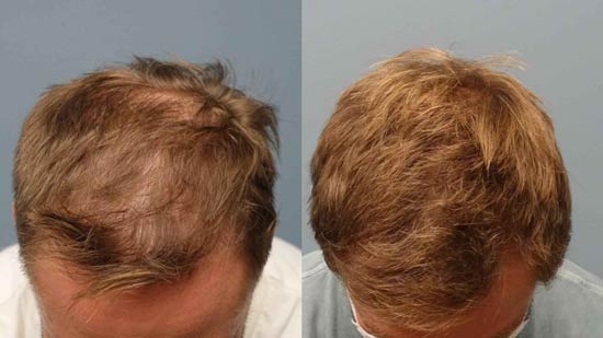 کاشت مو به روش sut چیست و چگونه انجام می شود؟