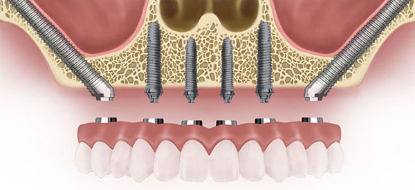 انواع ایمپلنت دندان از لحاظ نوع درمان، قرارگیری در استخوان فک و...