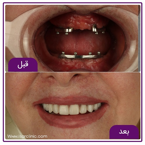 بهترین کلینیک کاشت دندان در شرق تهران- مراحل یک ایمپلنت دندانی