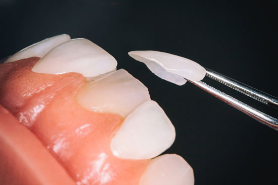 آشنایی با مراحل لمینت دندان (Dental Laminate)