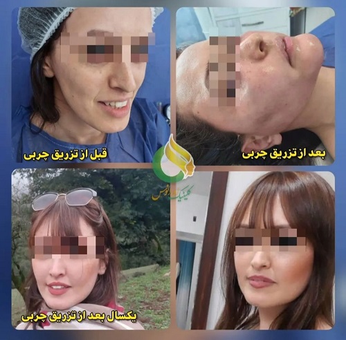 دکتر تزریق چربی در غرب تهران | ویژگی‌ها و نحوه یافتن