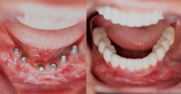 ایمپلنت دندان جلو چگونه انجام می‌شود؟ + مزایا و هزینه