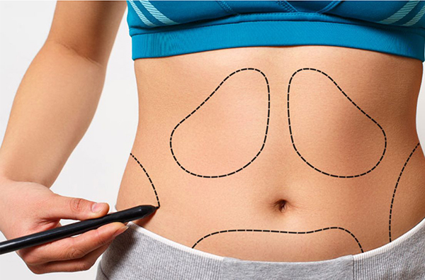هزینه جراحی شکم | قیمت عمل ابدومینوپلاستی یا زیبایی شکم (1401)