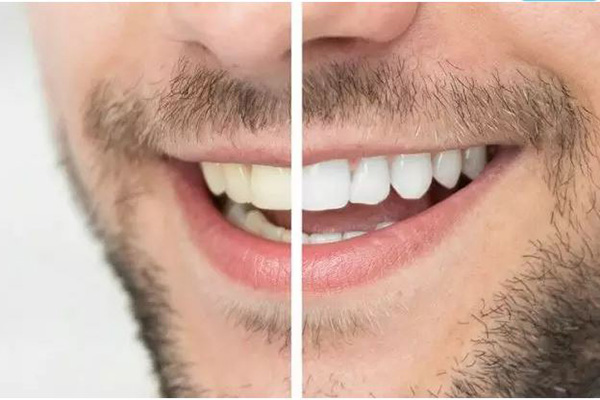 سفید کردن دندان | ۵ روش پزشکی و ۱۰ روش خانگی سفیدی دندان
