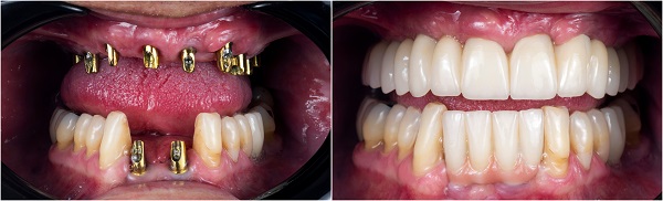 بهترین فاصله زمانی بین کشیدن دندان و کاشت ایمپلنت چقدر است؟