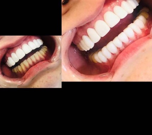 روکش دندان و لمینیت چه تفاوتی باهم دارند؟
