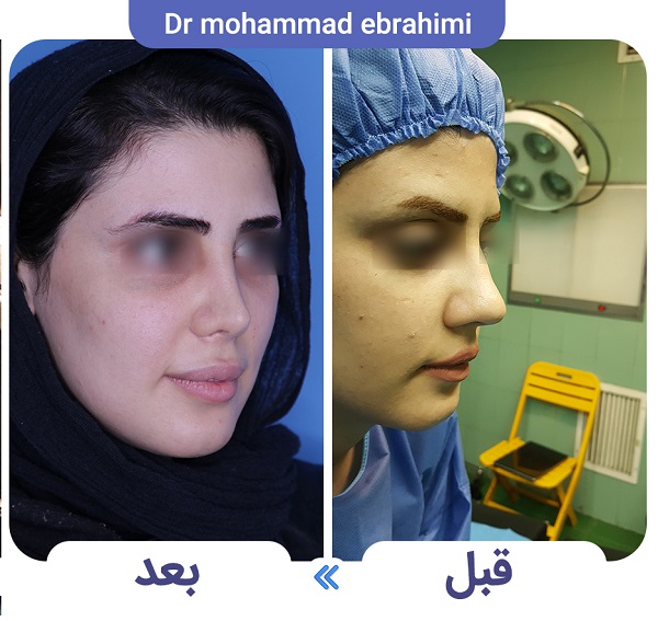 هزینه عمل جراحی بینی در سال 1402 + جدول قیمت