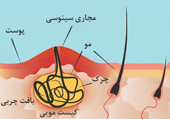 کیست مویی و عوامل ایجاد آن چیست؟