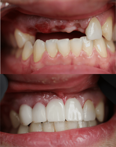 تفاوت ایمپلنت و لمینت دندان | بررسی مراحل، مزایا، معایب و کاربرد