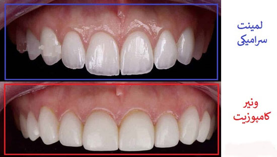 فرق کامپوزیت دندان با لمینت سرامیکی چیست؟ کدام یک بهتر است؟ 