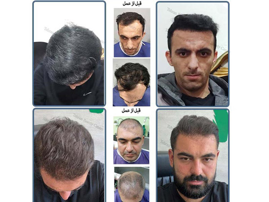معرفی رتبه 1 کلینیک های تخصصی کاشت مو در ایران