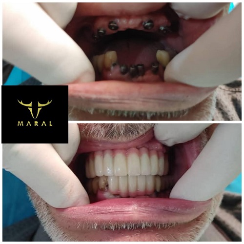 دندان مصنوعی با پایه ایمپلنت و مزایای آن