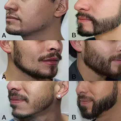 کاشت ریش و سبیل | روش ها، مراحل و هزینه کاشت ریش صورت