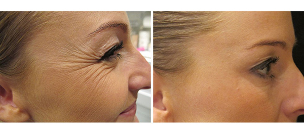 فیلر بهتر است یا بوتاکس | تفاوت تزریق بوتاکس و فیلر (ژل)