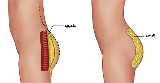 تزریق چربی به باسن چیست و چه مزایایی دارد؟