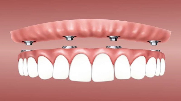 افزایش طول عمر ایمپلنت دندان + مشاوره رایگان