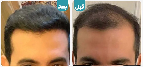 جراحی پیوند مو | انواع روش ها و هزینه