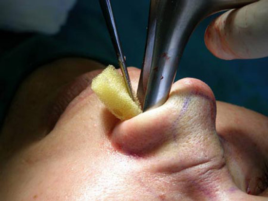 جراحی بینی بدون تامپون چیست و چگونه انجام می‌شود؟