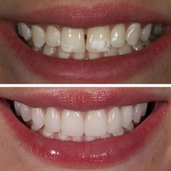 برای انتخاب بهترین لمینت دندان، چه معیارهایی مهم هستند؟