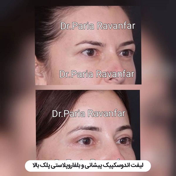 لیفت شقیقه با جراحی و هر آنچه باید درباره آن بدانید