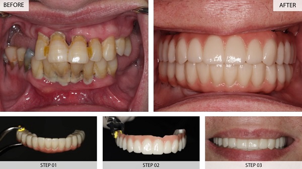 تفاوت ایمپلنت و لمینت دندان | بررسی مراحل، مزایا، معایب و کاربرد