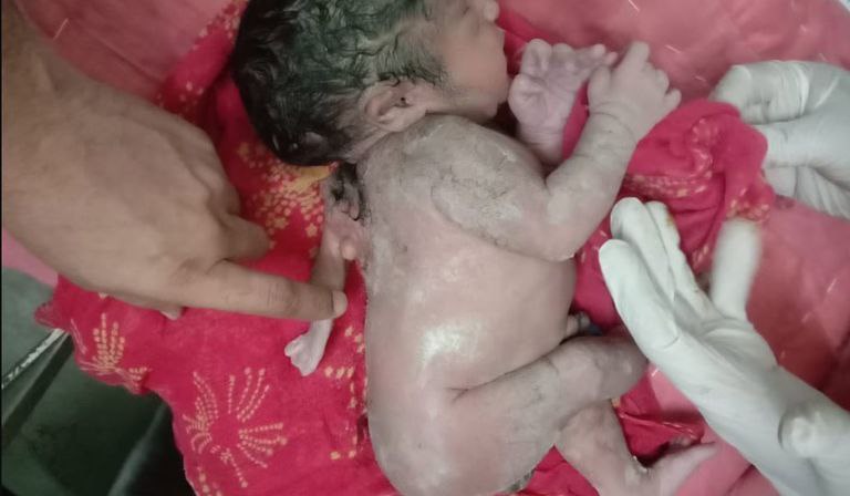 تصاویری تعجب‌برانگیز از تولد نوزاد پسر با سه دست!