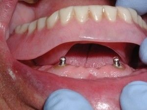 پروتز دندان چیست و چه انواعی دارد؟ 